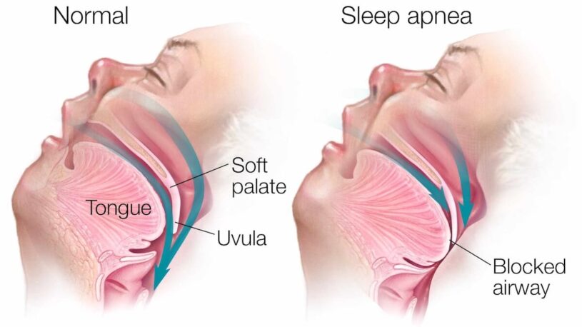 Understanding Sleep Apnea